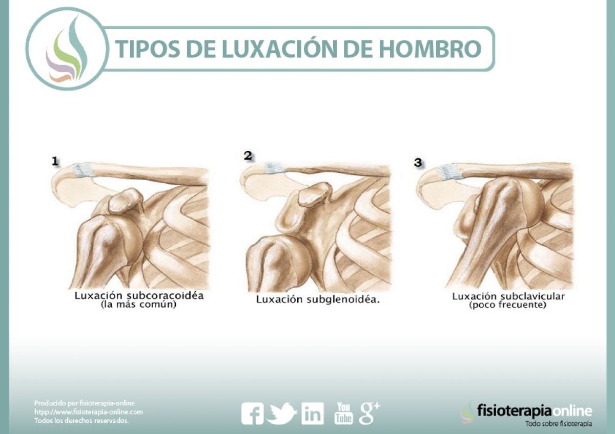 luxación, hombro, recurrente, recidivante, fisioterapia, lesiones, lesión, baloncesto, basket