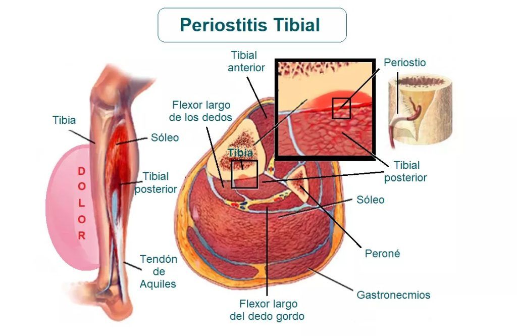 lesiones, fisioterapia, baloncesto, lesión, lesion, periostitis, tibial, tibia