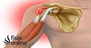 tendinitis, bicipital, bíceps, biceps, salud, lesión, fisioterapia, fisioterapeuta