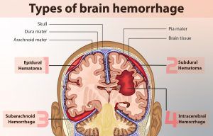 lesión, lesiones, hematoma, hematomas, epidural, epidurales, subdural, subdurales, lesion, fisioterapia, salud
