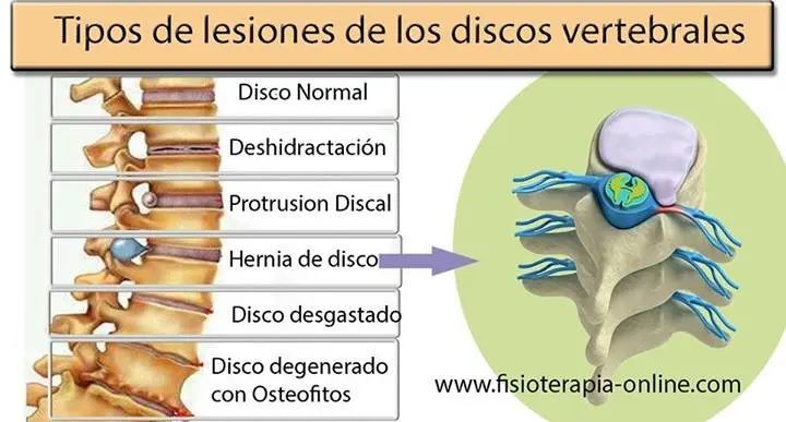 lesión, fisioterapia, salud, disco, cervical