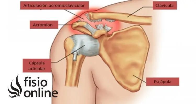 lesiones, fisioterapia, baloncesto, lesión, lesion, articulación, acromioclavicular