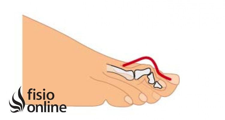 lesiones, fisioterapia, baloncesto, lesión, lesion, dedo, mazo, martillo