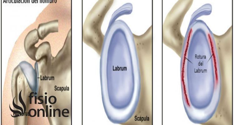 lesiones, fisioterapia, baloncesto, lesión, lesion, rodete, glenoideo