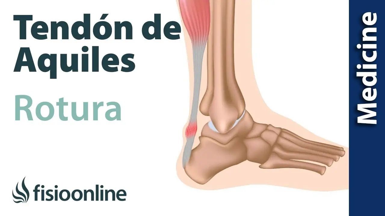 lesiones, fisioterapia, baloncesto, lesión, lesion, rotura, tendon, tendón, aquiles, Aquiles