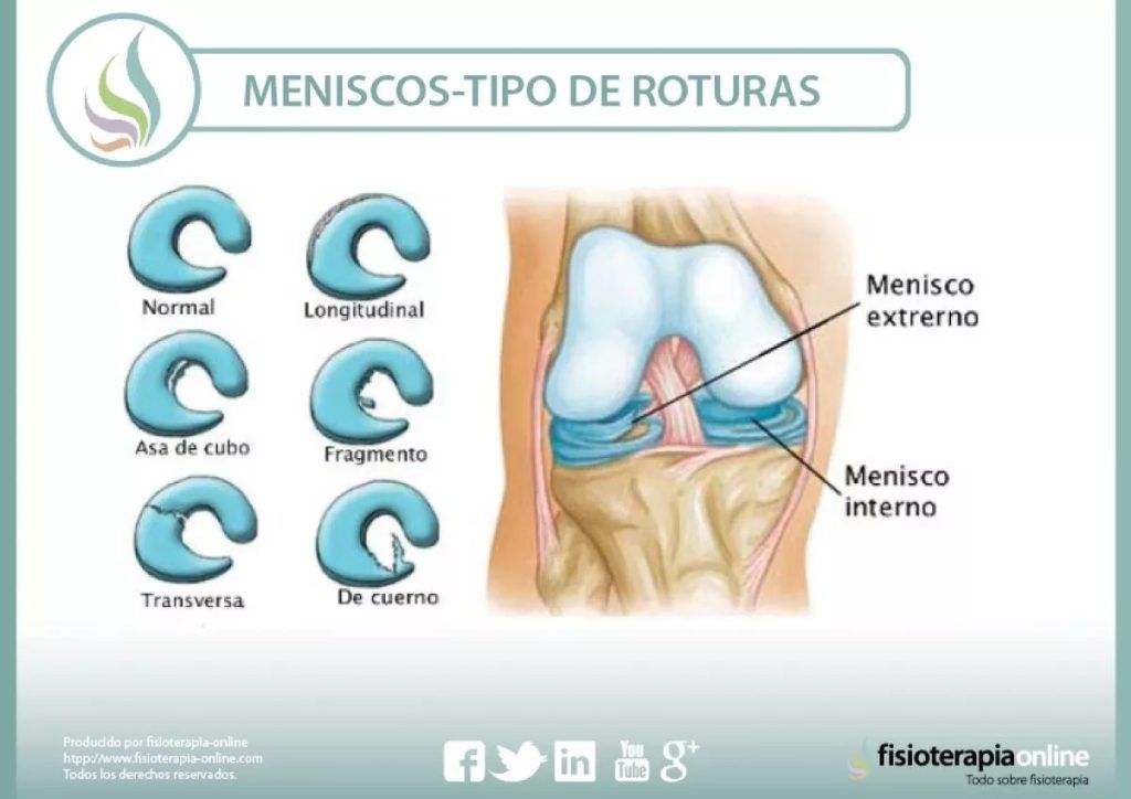 lesiones, fisioterapia, baloncesto, lesión, lesion, rotura, menisco, meniscal