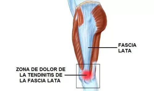 lesiones, fisioterapia, baloncesto, lesión, lesion, fascia, lata
