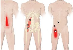 lesiones, fisioterapia, baloncesto, lesión, lesion, psoas, iliaco, ilíaco